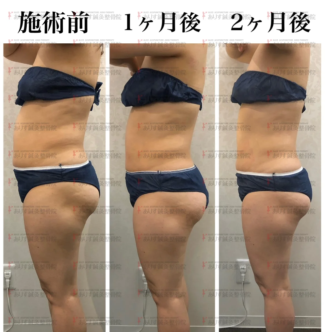 予約殺到！！脂肪冷却モニターとは？？高松市ビューティーアリスでお得